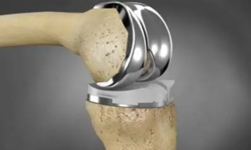 Which Material Is Best for Artificial Joints: Metal, Polymer, or Ceramic